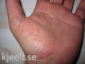 små kliande blåsor på händerna