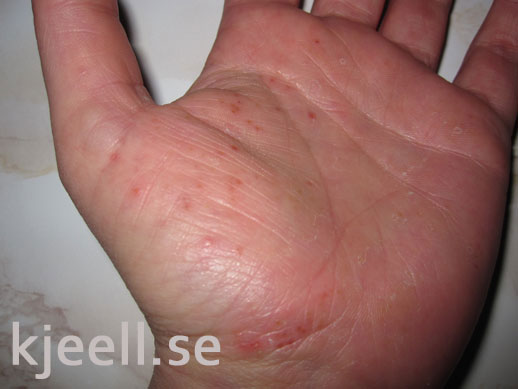 blåsor på händer och fötter som kliar